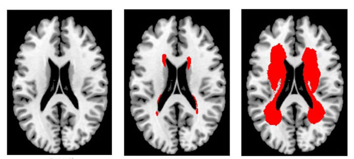 The above MRI images of the corona clinica in the brain are taken from patients who are aged between 65 and 74. The corona clinica is the central part of the cerebrum where motor and sensory nerves are located. The first grade image (left) shows barely any damage to the brain's blood vessels, while the images of the 50th and 100th percentiles (center, right) show partial or considerable damage to the blood vessels of the central part of the brain. The red color shows damaged blood vessels.